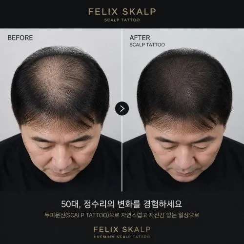 두피문신 필릭스스칼프 상담 안내 14