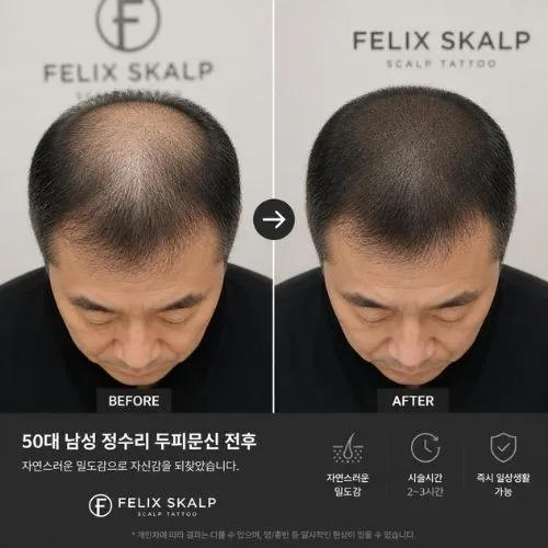 두피문신 필릭스스칼프 사후관리 15