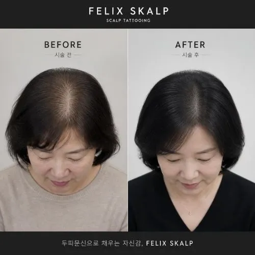 두피문신 필릭스스칼프 두피문신 교육 18