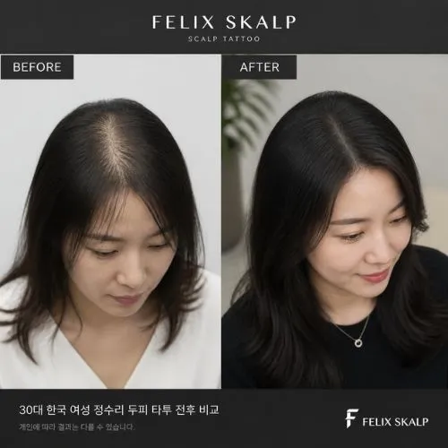 두피문신 필릭스스칼프 사후관리 20