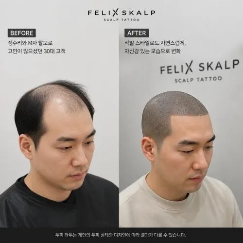 김포두피문신 두피문신 교육 3
